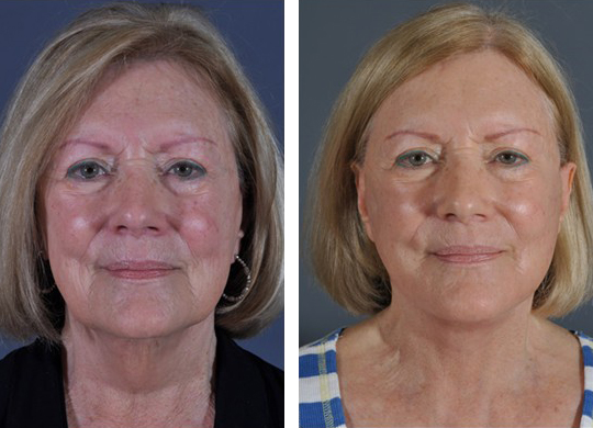 Dr. Dedo Face Lift Before and After 4