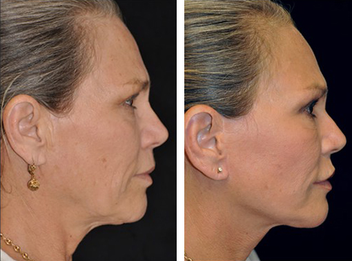 Dr. Dedo Face Lift Before and After 5